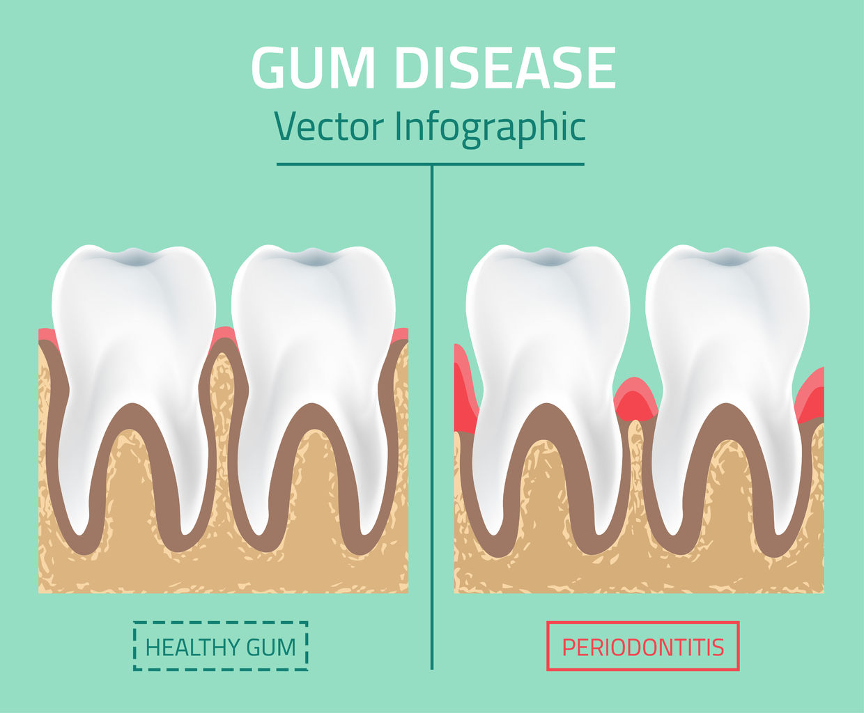 Cannabis and Gum Disease